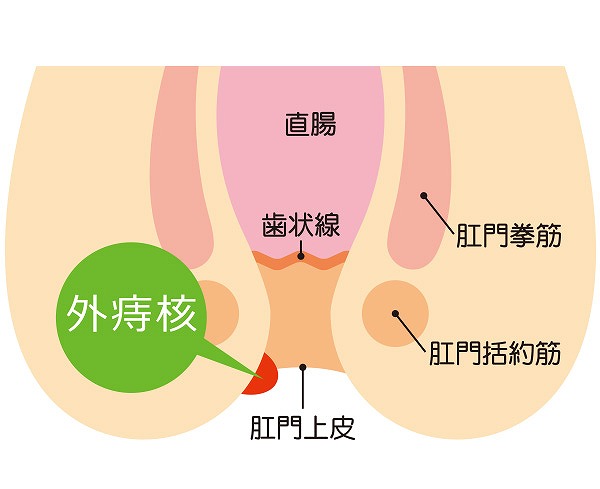 内痔核