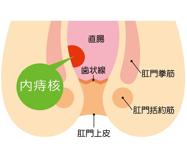 外痔核