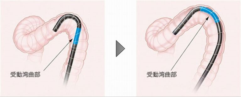 硬度調整機能を搭載したスコープ